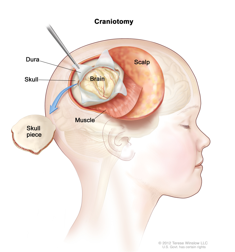 Drawing of a craniotomy showing a section of the scalp that has been pulled back to remove a piece of the skull; the dura covering the brain has been opened to expose the brain. The layer of muscle under the scalp is also shown.