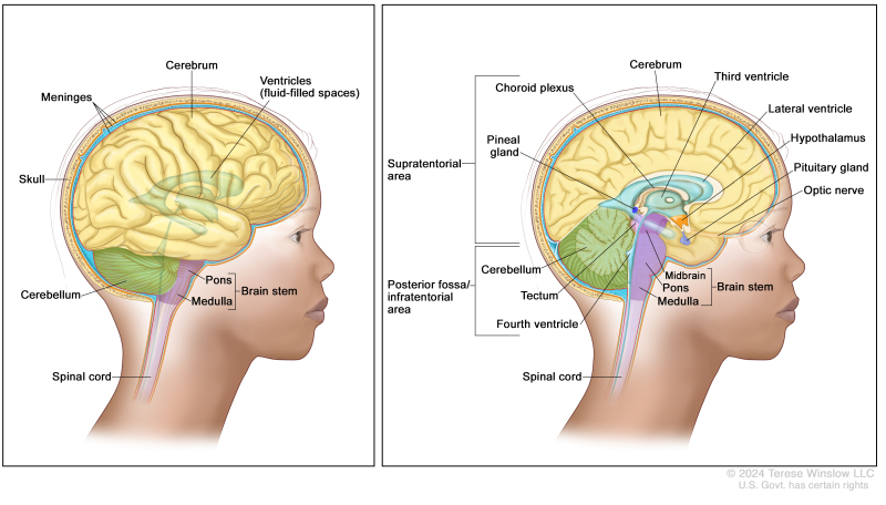 Anatomy of the brain; the right panel shows the supratentorial area (the upper part of the brain) and the posterior fossa/infratentorial area (the lower back part of the brain). The supratentorial area contains the cerebrum, lateral ventricle and third ventricle (with cerebrospinal fluid shown in blue), choroid plexus, pineal gland, hypothalamus, pituitary gland, and optic nerve. The posterior fossa/infratentorial area contains the cerebellum, tectum, fourth ventricle, and brain stem (midbrain, pons, and medulla). The spinal cord is also shown. The left panel shows the cerebrum, ventricles (fluid-filled spaces), meninges, skull, cerebellum, brain stem (pons and medulla), and spinal cord.