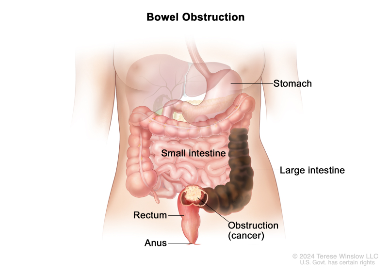 Drawing showing a large mass of dark brown stool in the large intestine caused by a tumor blockage. The tumor is at the end of the large intestine just before the rectum. Also shown are other parts of the digestive tract, including the stomach, small intestine, rectum, and anus.