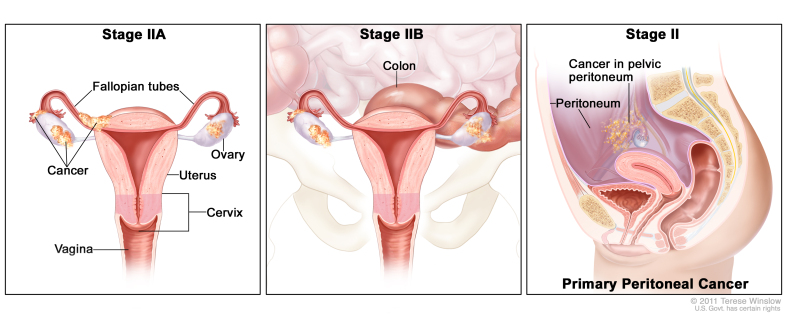 Three-panel drawing of stage IIA, stage IIB, and stage II primary peritoneal cancer; the first panel (stage IIA) shows cancer inside both ovaries that has spread to the fallopian tube and uterus . Also shown are the cervix and vagina. The second panel (stage IIB) shows cancer inside both ovaries that has spread to the colon. The third panel (primary peritoneal cancer) shows cancer in the pelvic peritoneum.