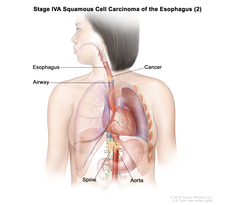 Stage IVA squamous cell carcinoma of the esophagus (2); drawing shows cancer in the esophagus, airway, aorta, and spine.