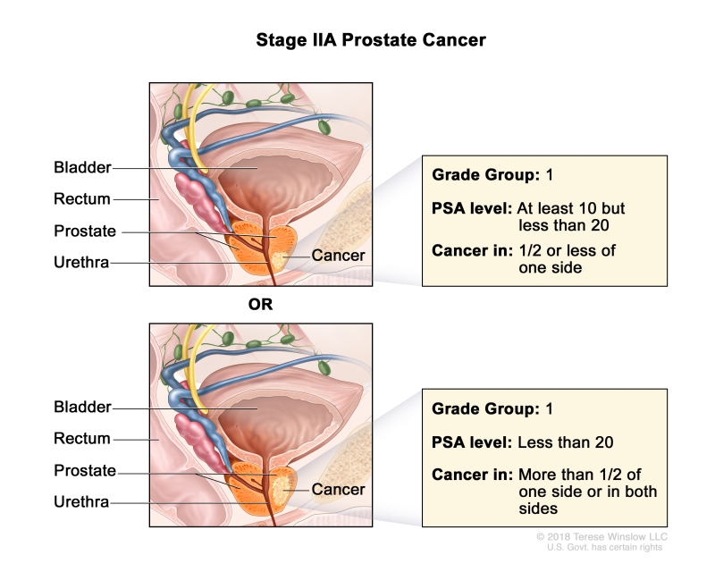 Two-panel drawing of stage IIA prostate cancer; the top panel shows cancer in one-half or less of one side of the prostate. The PSA level is at least 10 but less than 20 and the Grade Group is 1. The bottom panel shows cancer in more than one-half of one side of the prostate. The PSA level is less than 20 and the Grade Group is 1. In both panels, the bladder, rectum, and urethra are also shown.