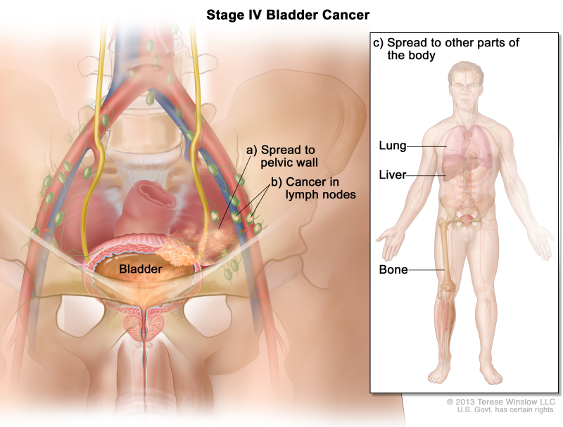 Stage IV bladder cancer; drawing shows cancer in the bladder, the pelvic wall, and lymph nodes. Inset shows some other parts of the body where cancer can spread from the bladder: the lung, liver, and bone.
