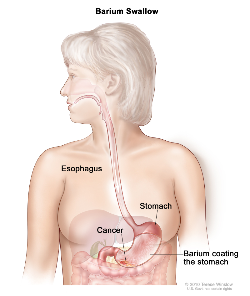 Barium swallow for stomach cancer; drawing shows barium liquid flowing through the esophagus and into the stomach.