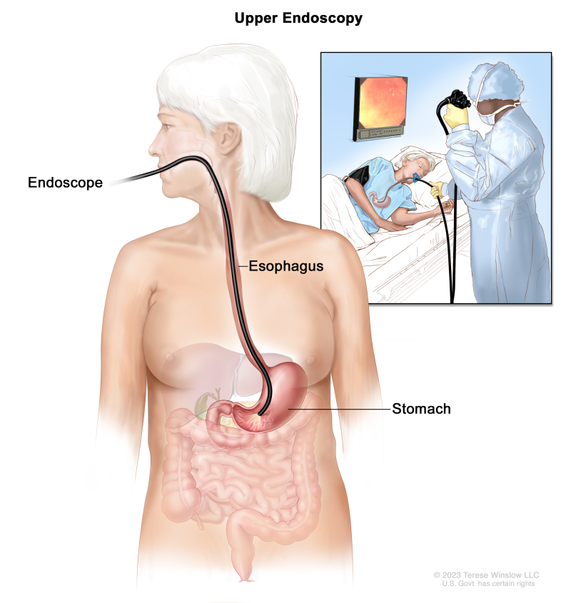 Upper endoscopy; drawing shows an endoscope (a thin, lighted tube) inserted through the mouth and down the throat into the esophagus and stomach. An inset shows a patient on a table having an upper endoscopy.