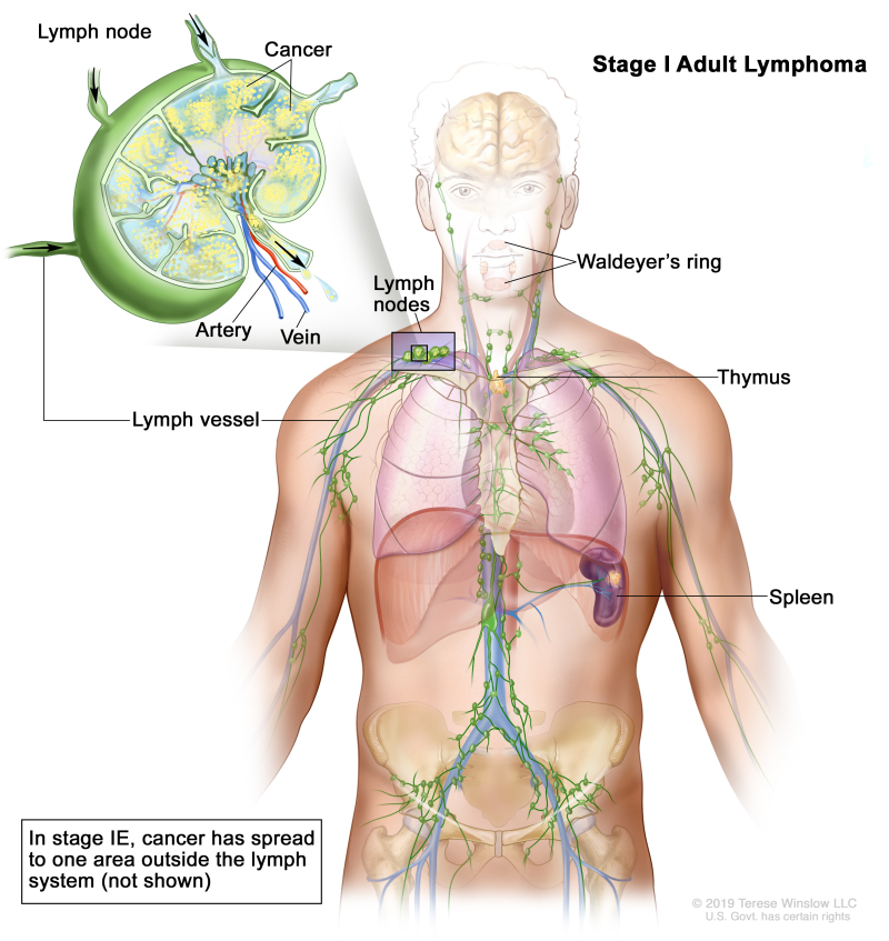 Stage I adult lymphoma; drawing shows cancer in one lymph node group and in the spleen. Also shown are the Waldeyer’s ring and the thymus. An inset shows a lymph node with a lymph vessel, an artery, and a vein. Cancer cells are shown in the lymph node.