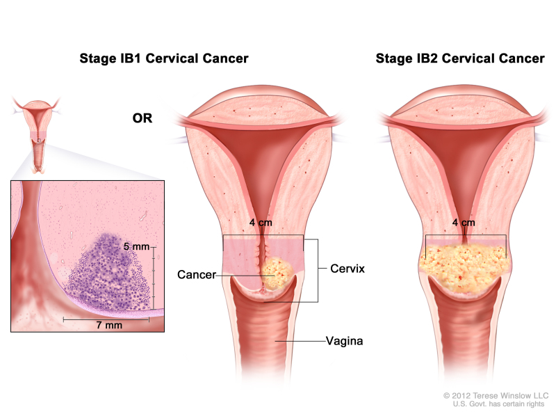 Stage IB1 and IB2 cervical cancer shown in three cross-section drawings of the cervix and vagina. An inset on the left shows stage IB1 cancer that is 7 mm wide and more than 5 mm deep. Drawing in the middle shows stage IB1 cancer that is smaller than 4 cm. Drawing on the right shows stage IB2 cancer that is larger than 4 cm.
