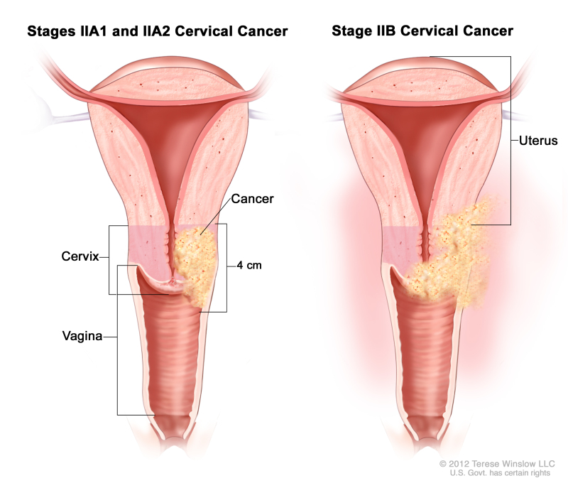 Stage II cervical cancer; drawing shows a cross-section of the uterus, cervix and vagina. In stages IIA1 and IIA2, cancer that is 4 cm is shown in the cervix and in the upper third of the vagina. In stage IIB, cancer is shown in the cervix, the upper two thirds of the vagina, and in the tissues around the uterus.