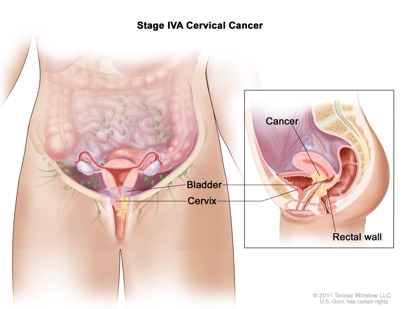 Stage IVA cervical cancer; drawing and inset show that cancer has spread from the cervix to the bladder and rectal wall.