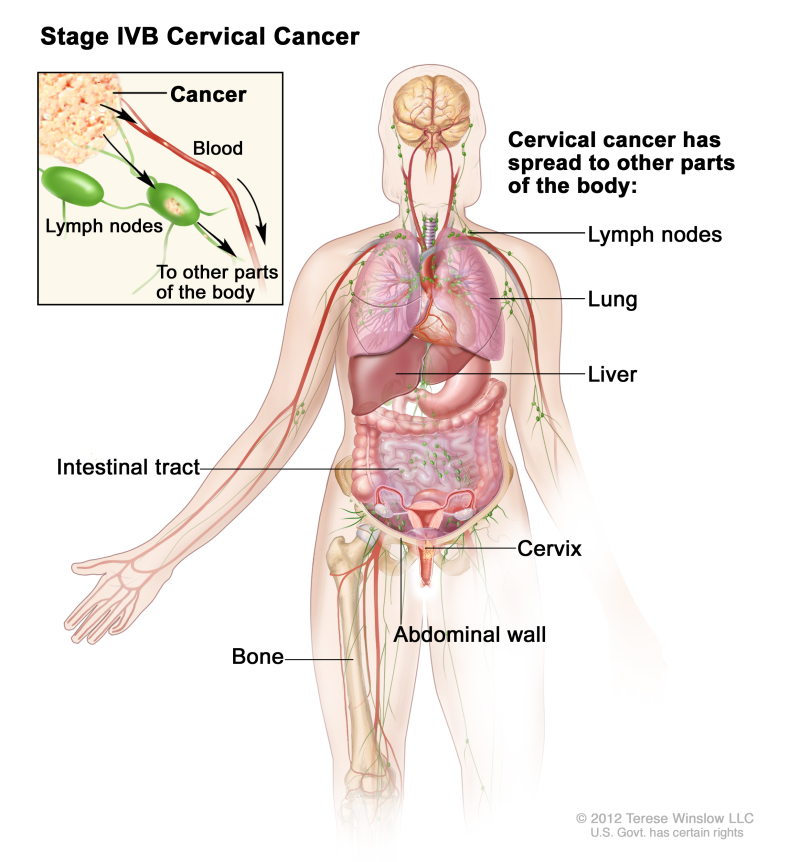 Stage IVB cervical cancer; drawing shows other parts of the body where cervical cancer may spread, including the lymph nodes, lung, liver, intestinal tract, abdominal wall, and bone. An inset shows cancer cells spreading from the primary cancer, through the blood and lymph system, to another part of the body where metastatic cancer has formed.