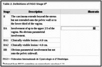 Table 2. Definitions of FIGO Stage IIa.