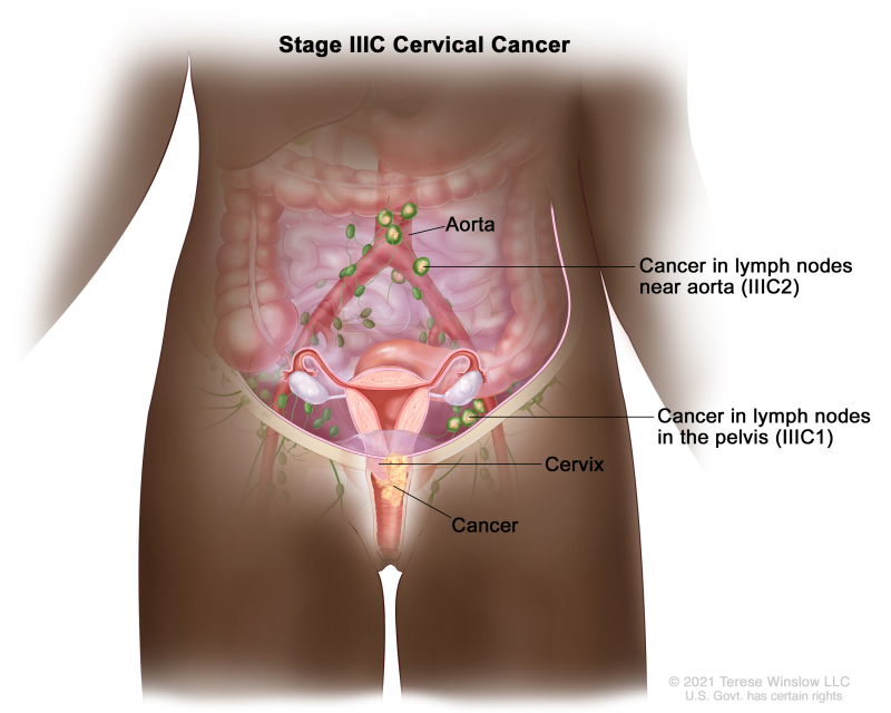 Stage IIIC cervical cancer; drawing shows stage IIIC1 cancer that has spread from the cervix to lymph nodes in the pelvis and stage IIIC2 cancer that has spread from the cervix to lymph nodes near the aorta.