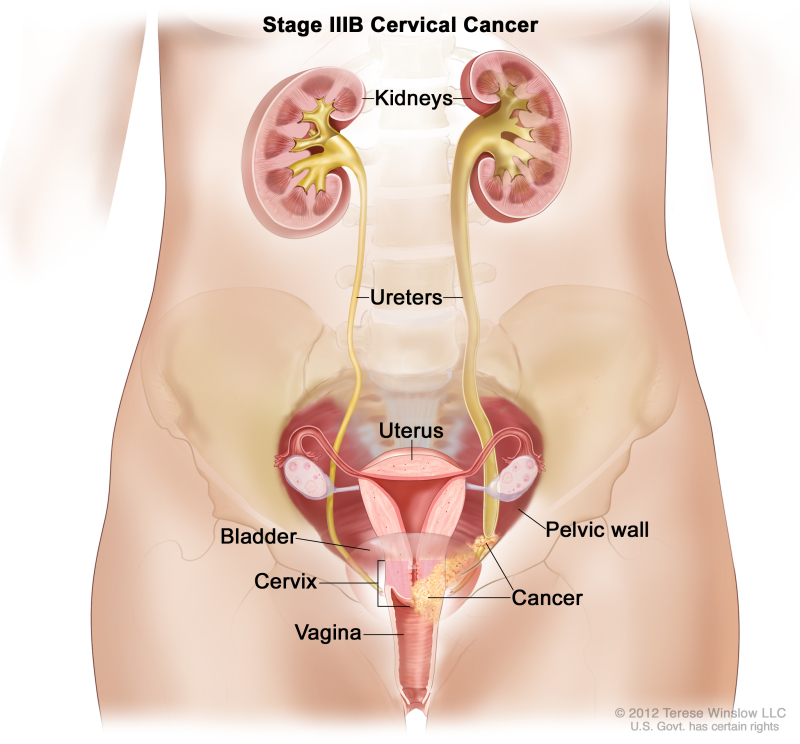 Stage IIIB cervical cancer; drawing shows cancer in the cervix, the vagina, and the pelvic wall, blocking the ureter on the right. The uterus and kidneys are also shown.