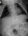 Figure 5. . Radiograph of child with HES7-related SCDO.
