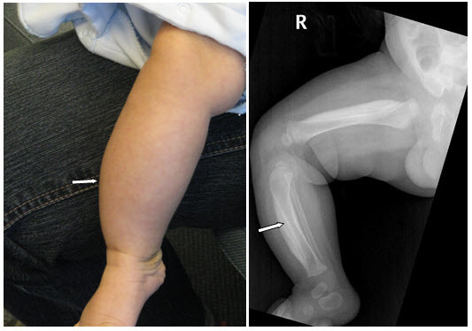Figure 2. . Clinical photograph and x-ray of male age two months with the defining COL1A1 p.